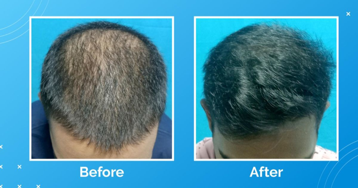 Vcare’s Treatment For Hair Loss And Hair Thinning